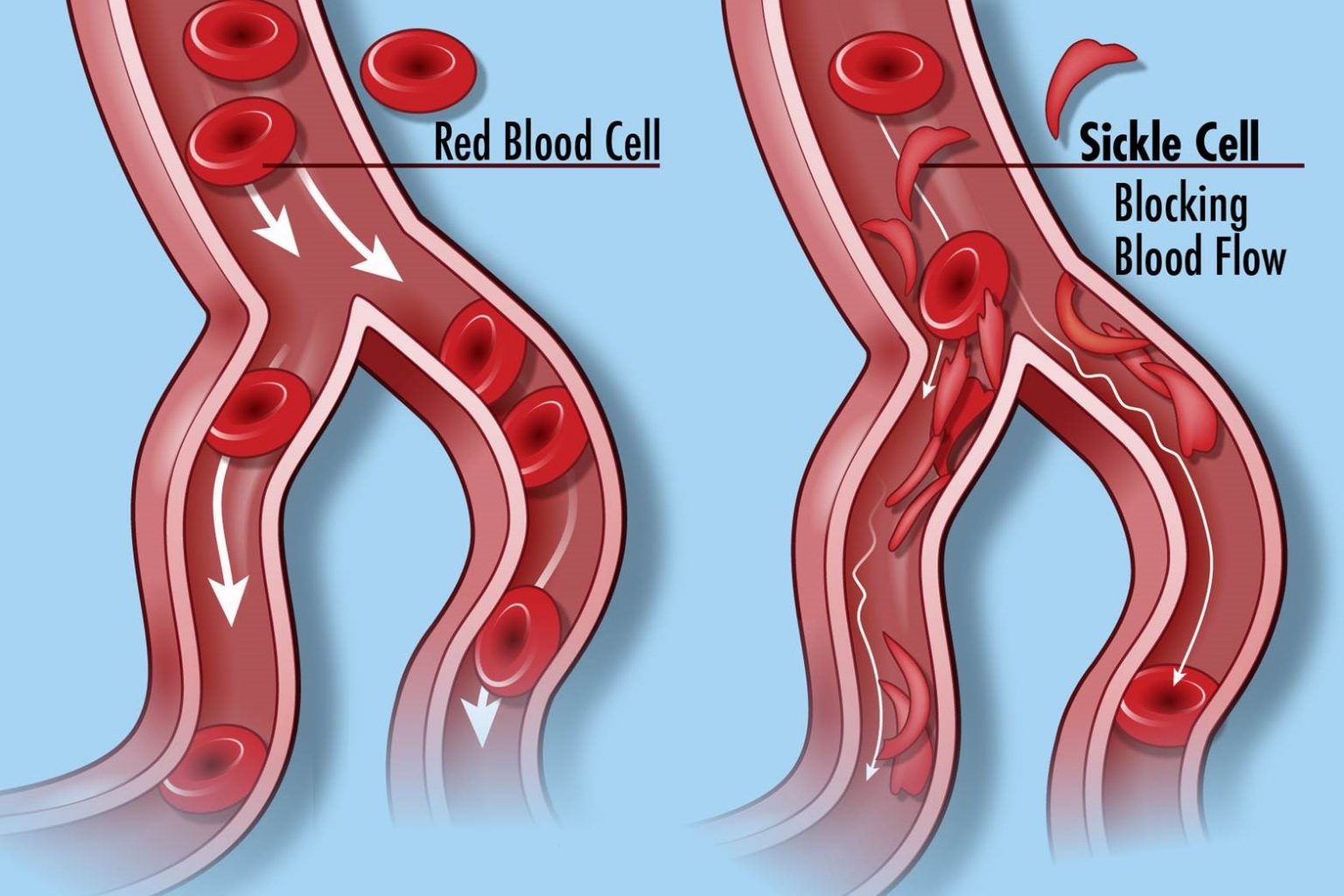 Sickle cell anemia and malaria Simplebiol
